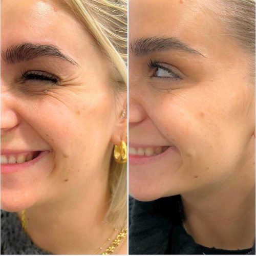 1 vial acido hialuronico 1 vial acido hialuronico